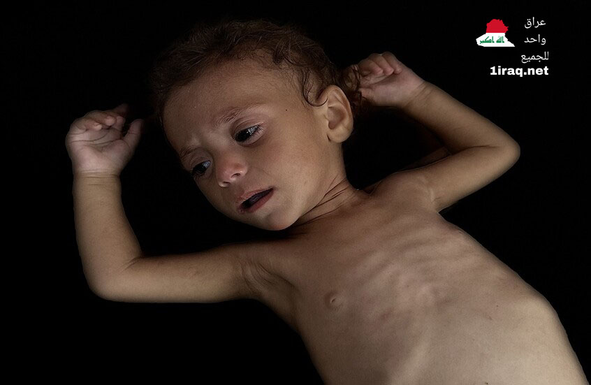 وفاة الطفل الغزاوي صاحب صرخة "أنا جعان" في تركيا